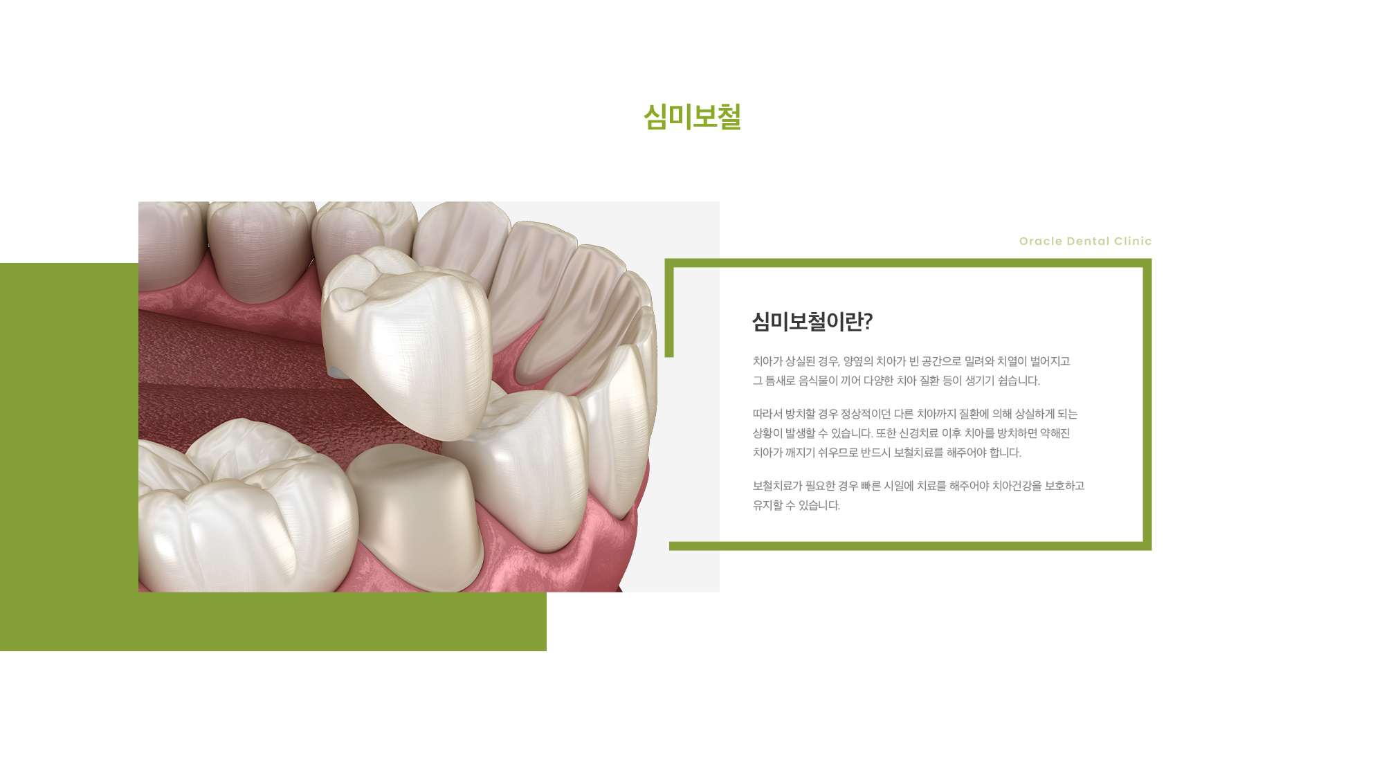 심미 보철