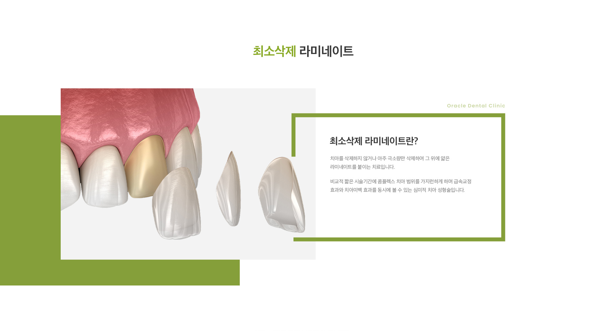 최소삭제 라미네이트