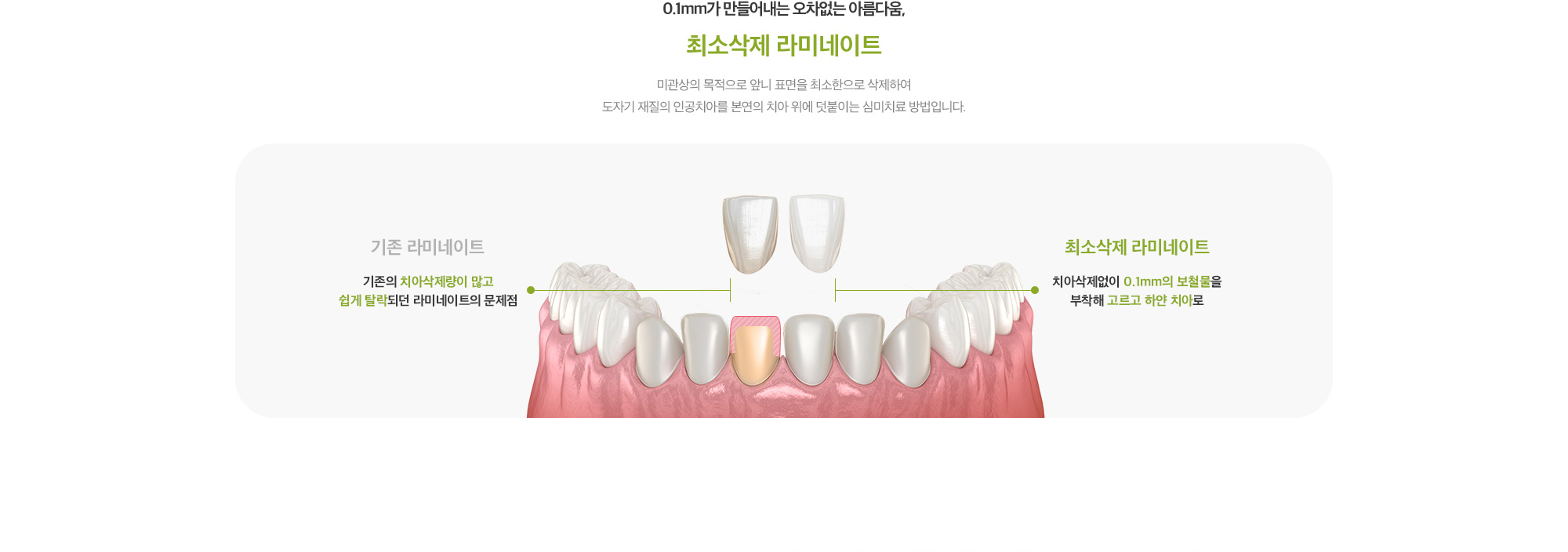 최소삭제 라미네이트