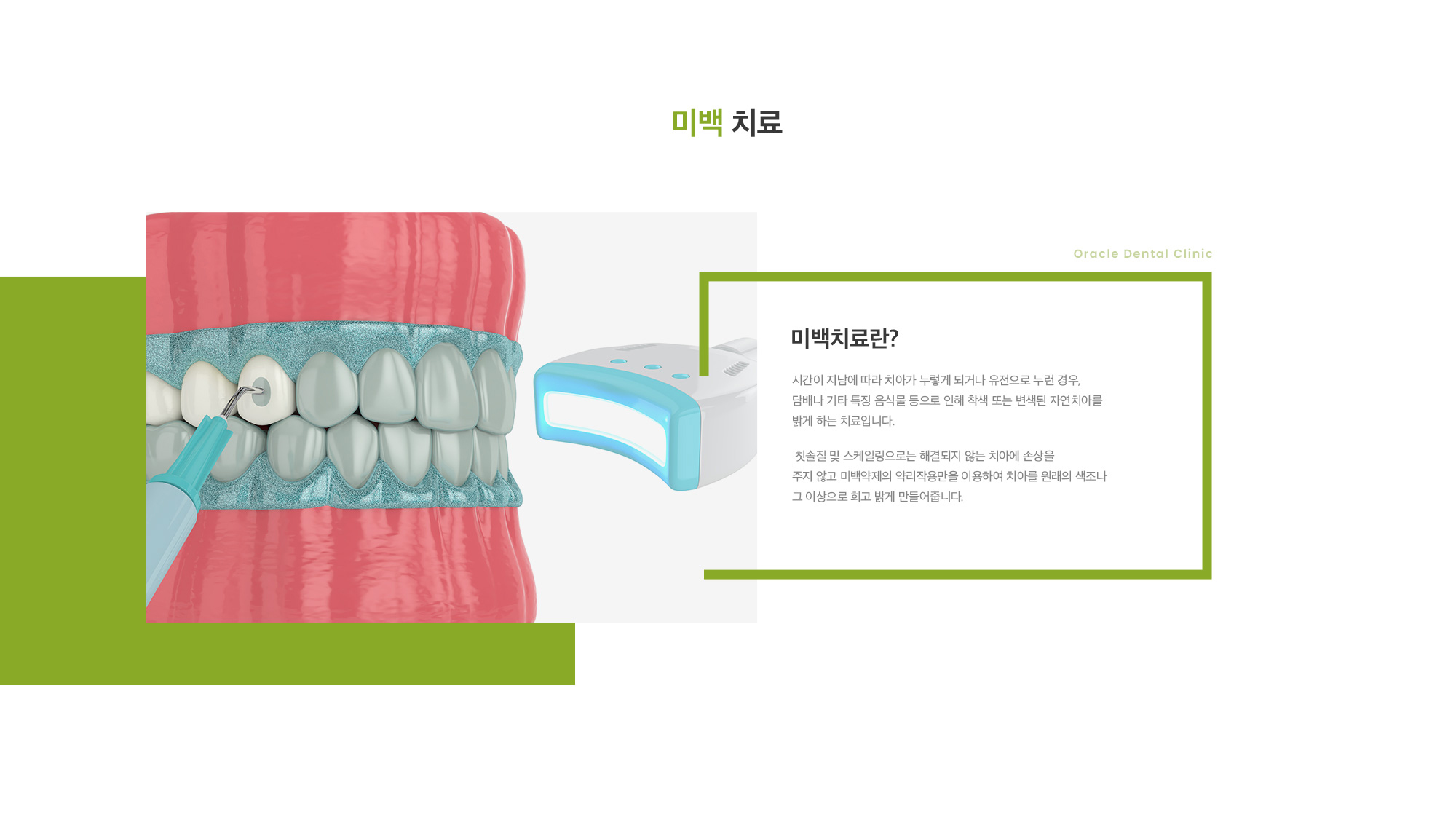 미백치료