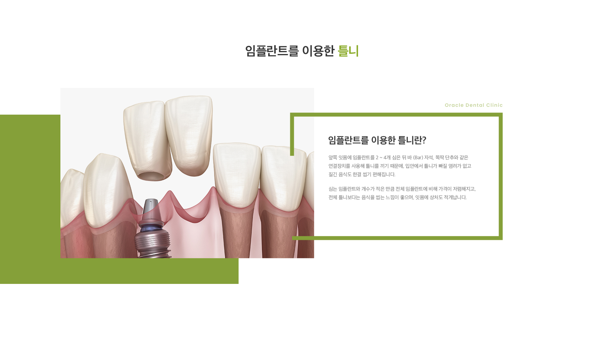 임플란트를 이용한 틀니란? 앞쪽 잇몸에 임플란트를 2 ~ 4개 심은 뒤 바 (Bar) 자석, 똑딱 단추와 같은 연결장치를 사용해 틀니를 끼기 때문에, 입안에서 틀니가 빠질 염려가 없고 질긴 음식도 한결 씹기 편해집니다. 심는 임플란트와 개수가 적은 만큼 전체 임플란트에 비해 가격이 저렴해지고, 전체 틀니보다는 음식을 씹는 느낌이 좋으며, 잇몸에 상처도 적게납니다. 