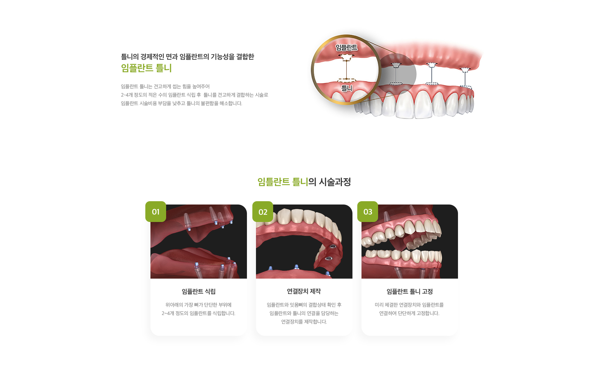 틀니의 경제적인 면과 임플란트의 기능성을 결합한 임플란트 틀니 임플란트 틀니는 견고하게 씹는 힘을 높여주어 2-4개 정도의 적은 수의 임플란트 식립 후  틀니를 견고하게 결합하는 시술로 임플란트 시술비용 부담을 낮추고 틀니의 불편함을 해소합니다.