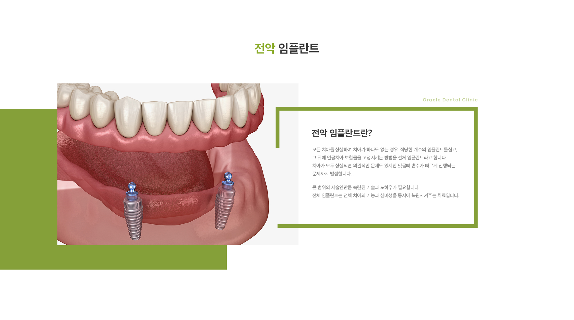 전악 임플란트란? 모든 치아를 상실하여 치아가 하나도 없는 경우, 적당한 개수의 임플란트를심고, 그 위에 인공치아 보철물을 고정시키는 방법을 전체 임플란트라고 합니다. 치아가 모두 상실되면 외관적인 문제도 있지만 잇몸뼈 흡수가 빠르게 진행되는 문제까지 발생합니다. 큰 범위의 시술인만큼 숙련된 기술과 노하우가 필요합니다. 전체 임플란트는 전체 치아의 기능과 심미성을 동시에 복원시켜주는 치료입니다. 