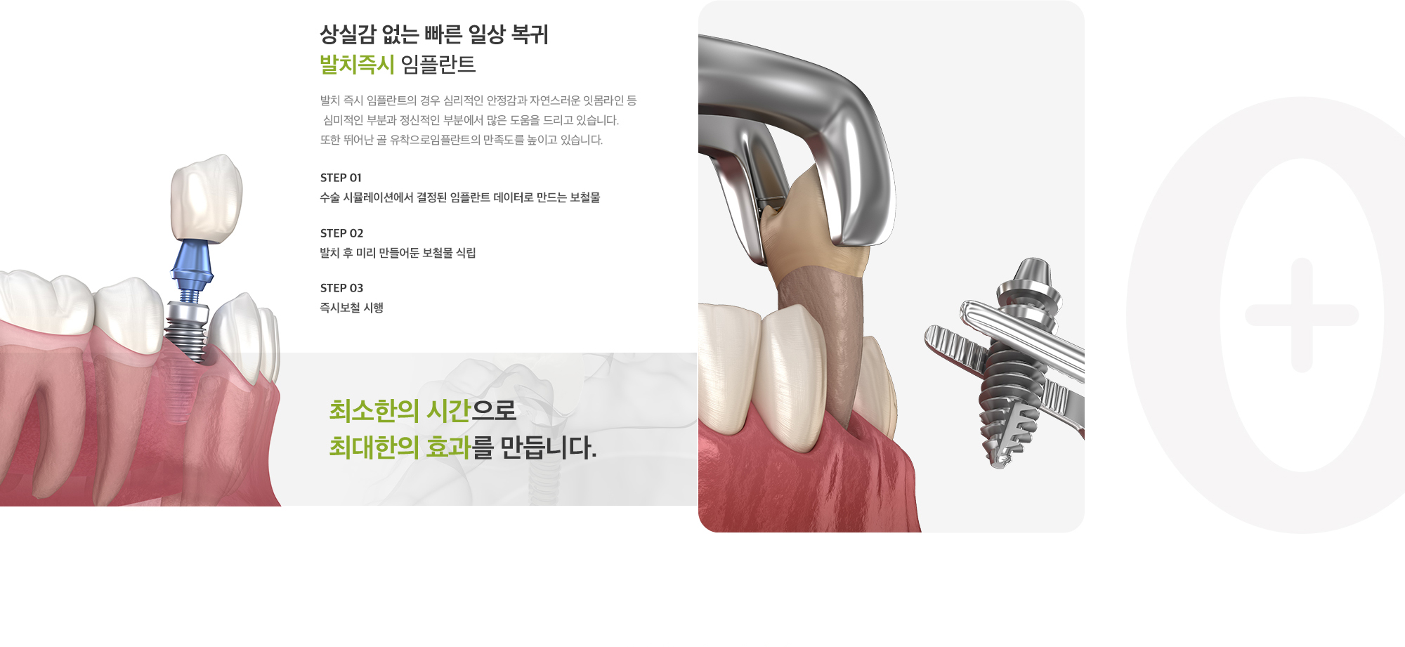 상실감 없는 빠른 일상 복귀 발치즉시 임플란트 발치 즉시 임플란트의 경우 심리적인 안정감과 자연스러운 잇몸라인 등, 심미적인 부분과 정신적인 부분에서 많은 도움을 드리고 있습니다. 또한 뛰어난 골 유착으로임플란트의 만족도를 높이고 있습니다. 