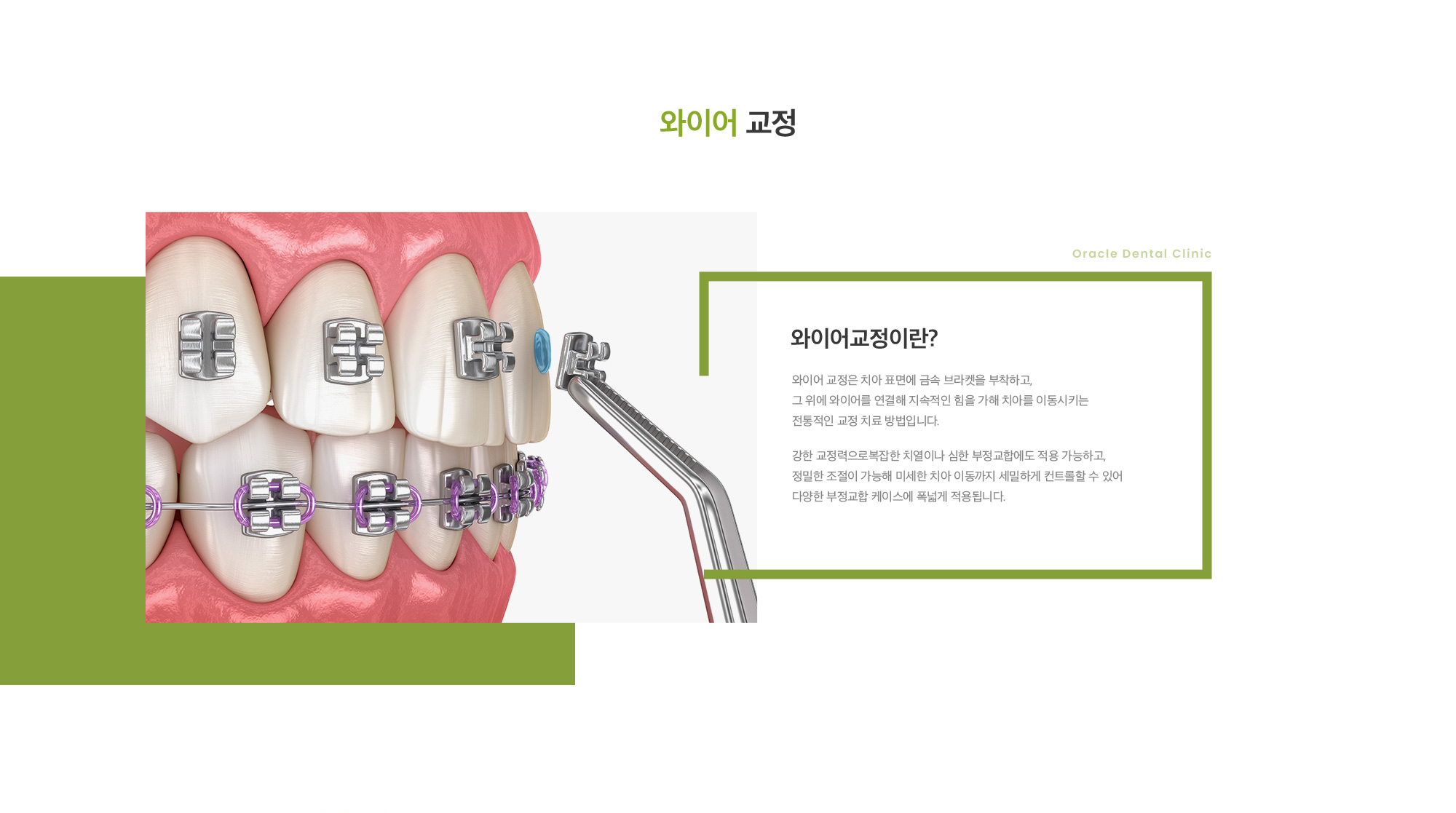와이어교정이란? 와이어 교정은 치아 표면에 금속 브라켓을 부착하고, 그 위에 와이어를 연결해 지속적인 힘을 가해 치아를 이동시키는 전통적인 교정 치료 방법입니다. 강한 교정력으로복잡한 치열이나 심한 부정교합에도 적용 가능하고, 정밀한 조절이 가능해 미세한 치아 이동까지 세밀하게 컨트롤할 수 있어 다양한 부정교합 케이스에 폭넓게 적용됩니다.